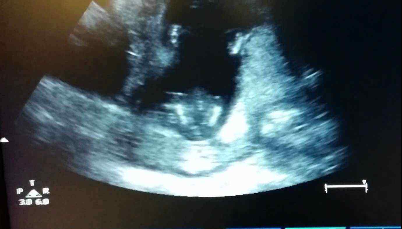 Download Video: Ultrasound Scan Shows Unborn Baby Clap In Mother’s Womb As She Sings