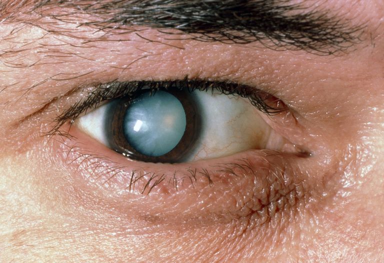 Eye with Cataract