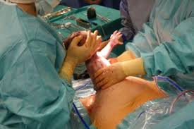 Research; More women die from caesarean delivery in Africa