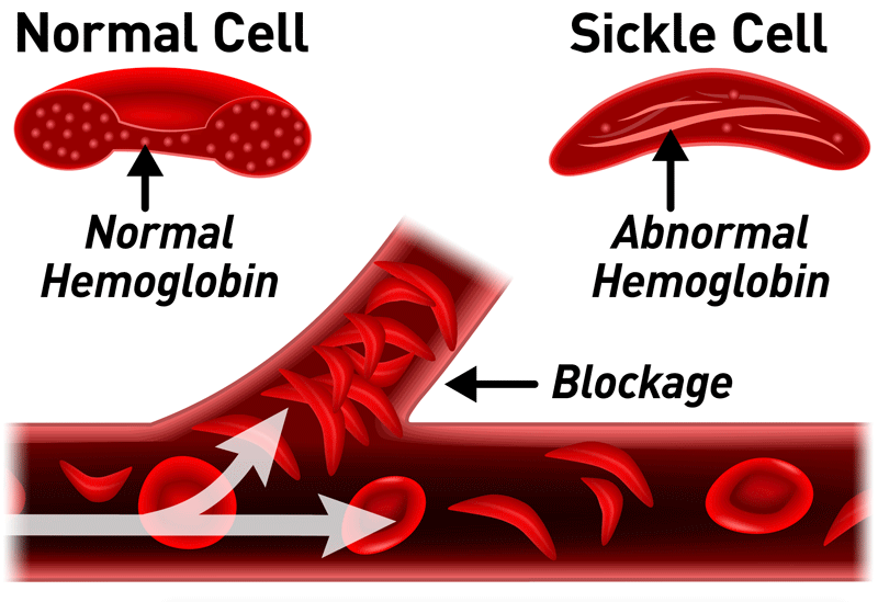 Sickle cell: How to live fulfilled life – Experts