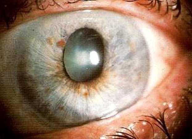 Ensure regular eye check to forestall glaucoma -  Expert
